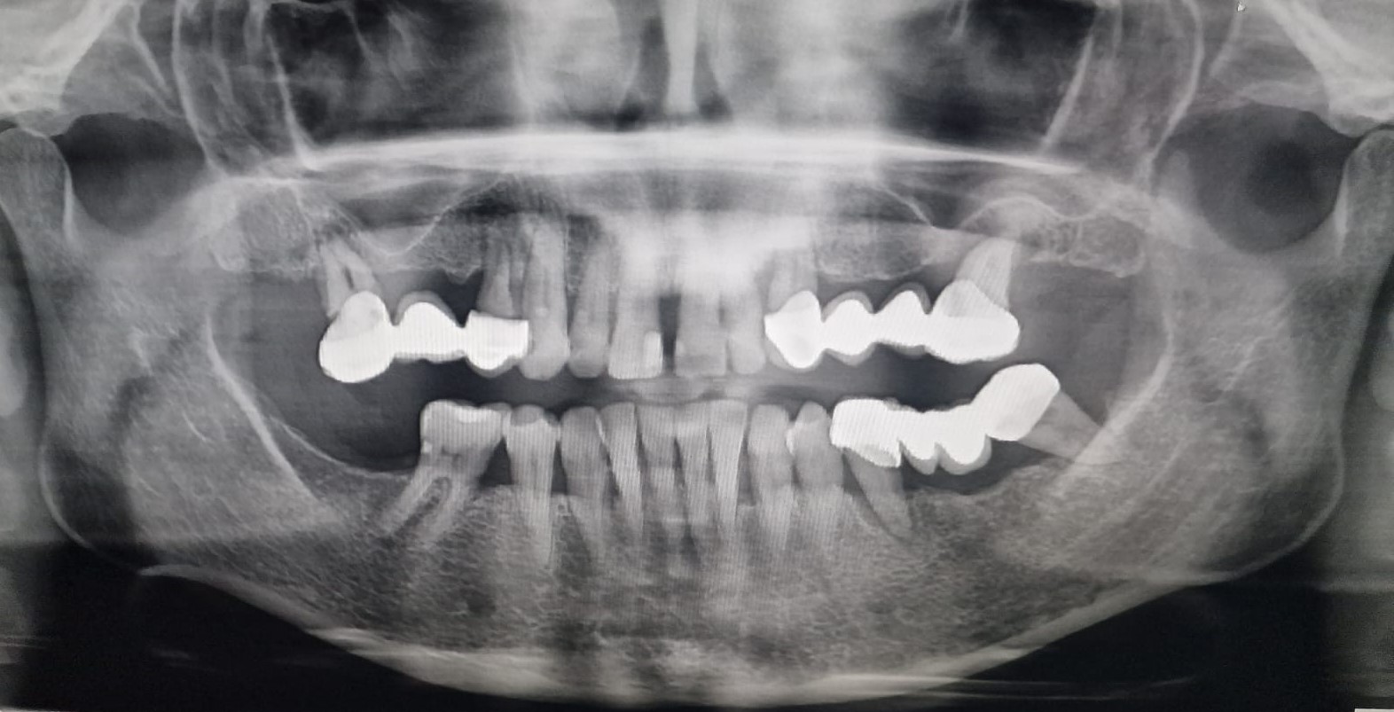 Rx rehabilitación superior 2 antes