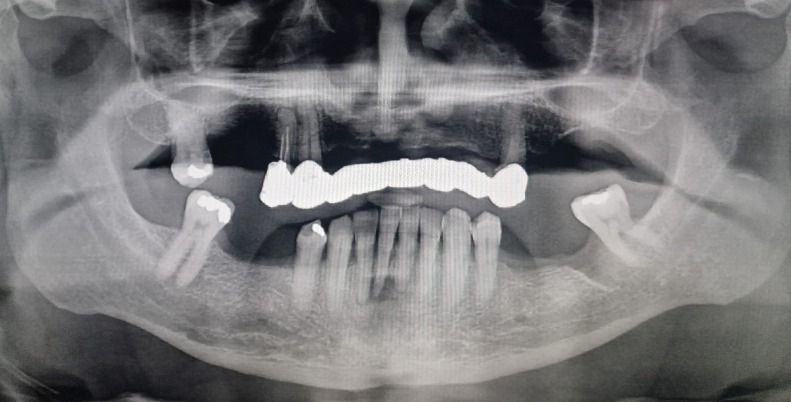 Rx rehabilitación superior e inferior antes